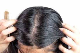 Tutte le cause · eccesso di sebo, che può dipendere da · squilibri ormonali, · stress, assunzione di · farmaci e altre circostanze che stimolano la . Come Agire Sui Capelli Grassi Tutti I Rimedi Naturali Per Assorbire Il Sebo