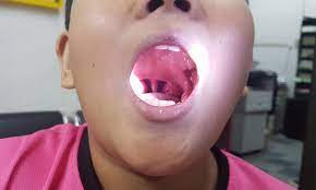Saya makan aiskrim wall vanila untuk digantikan ubat bagi sakit tekak saya,ianya dapat mengurangkan rasa perit tekak saya,rasanya juga sedap,apabila ditambah dgn bermacam jenis topping seperti coklat urai,oreo,chipsmore dan lain2. Doktor Dedah Makan Aiskrim Vanila Ubati Tonsil Bengkak Mengarut