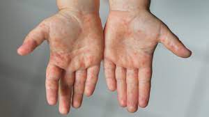 monkeypox Suspected patient in Ghaziabad Symptoms seen in 5 year old girl  गाजियाबाद में मंकीपॉक्स की दस्तक? 5 साल की बच्ची में दिखे लक्षण, जांच को गए  सैंपल - India Ahead Hindi