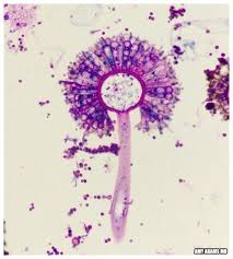 An outpatient may give a history of penetrating trauma involving soil or vegetation. Aspergillus Fumigatus V A Dandelion Microbiology Medical Laboratory Science Microscopic Photography