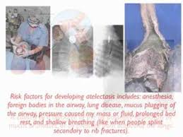 Mucus plugs are also common in children, people with cystic fibrosis and during severe asthma attacks. Atelectasis Youtube