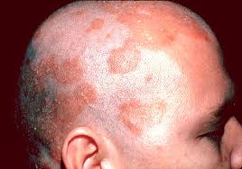 Slikovni rezultat za Atopijski dermatitis (neurodermitis)