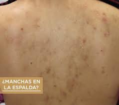 M B Atencion En Santacruz Este Sabado 10 De Noviembre El Acne Te Dejo Manchitas En La Espalda Entonces Es Hora De Tratarlas Cuando Hemos Tenido Acne No Solo Aparecen