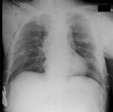Image result for Open Pneumothorax