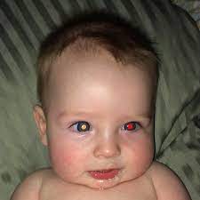 Update Pg 6 Flash Photo With Yellow Eye Babycenter