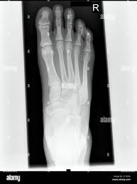 Image result for Foot XRay