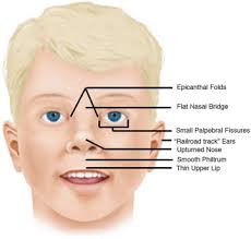 Epicanthic folds is a skin fold on the upper eyelid which covers the inner angle of the eye, which makes them appear smaller and more slanted, even if the eye itself is no different from an eye with no epicanthic fold. Ultrasound Features Of Fetal Syndromes Radiology Key