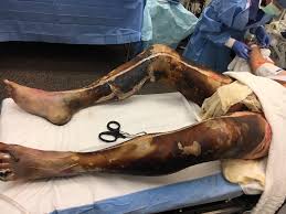 An escharotomy is a surgical procedure performed to allow greater circulation to that part of the body. 3rd 4th Degree Burns With Escharotomies Medicalgore