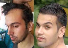 Eine wissenschaftliche studie belegt dies. Haartransplantation Vorher Nachher Bild Erfahrungen Haartransplantation Frisuren Bei Haarausfall Haarausfall