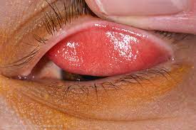 Conjunctivitis