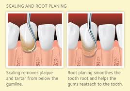 How do you dissolve plaque? Scaling And Root Planing For Gum Disease American Dental Association