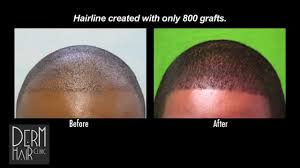 Fue has become more popular than the follicular unit transplantation (fut) procedure, which led to the hair plugs look. Successful Fue Hair Transplant For African American Patient 1200 Grafts Fue Hair Transplant Hair Transplant Grafting