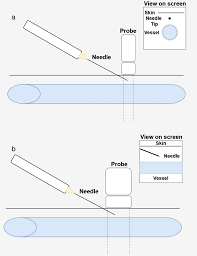 Image result for Difficult Intravenous Access in Children