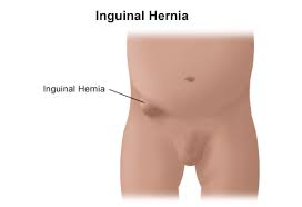 Image result for Inguinal hernia man