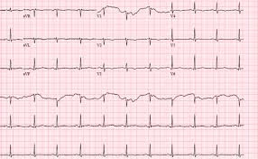 Mg is sometimes identified as having an ocular and generalized form. Cureus Cardiac Adverse Events With Remdesivir In Covid 19 Infection