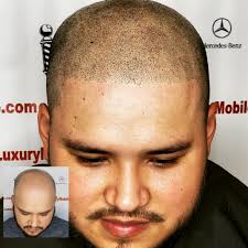 Besides, remember to avoid firmly pressing on the hairline, as it might stunt the hair development. Twain Taylor On Twitter Take Off That Hat Covering Your Baldness Scalpmicropigmentation Can Fix That Bringing Your Hairline Back To Life I Have Amazing 5 Star Yelp Google Reviews Hairloss Balding