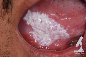 Image result for Erythroplakia roof of mouth