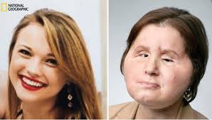 Hy hữu ca cấy ghép khuôn mặt từ người thân kéo dài 31 tiếng đồng hồ