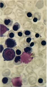 Image result for Peripheral Smear