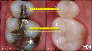 Maybe you would like to learn more about one of these? Replace Silver Fillings With Natural Biomimetic Restorations