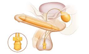 Image result for Penile Prosthesis
