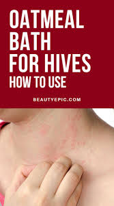 Oatmeal Bath Remedy For Hives How To Use Hives Remedies Allergy Remedies Natural Cough Remedies