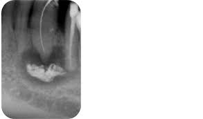Calcium Hydroxide In Endodontics An Overview