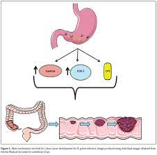 A Review Of Helicobacter Pylori And Colon Cancer