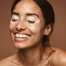 Vitiligo-dermatološki poremećaj pigmentacije