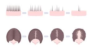 Die Ursachen Fur Haarausfall Bei Jungen Frauen Wmn