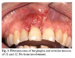 Inner cheek cancer (also called buccal mucosa cancer) is a type of head and neck cancer that begins when the cells that make up the inner cheek grow out of control and form lesions or tumors. Oral Non Squamous Malignant Tumors Diagnosis And Treatment