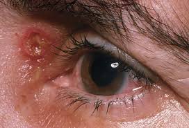 1) when you touch an ingrown hair, it feels rough. Genital Herpes Causes Treatment And Prevention