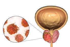 Image result for Prostate Cancer
