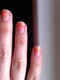 The basics of acrylic nails for beginners! Ø§Ø­ØªØ§Ø¬ Ø§ÙØªØ®ÙÙÙ Ø­Ø¨ÙØ¨Ù Nail Bed Lifting Outofstepwineco Com