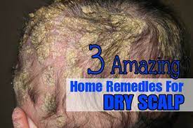 Dandruff is the result of the overproduction of dead skin, but it can also be caused by numerous other factors — such as winter air that produces dry skin, a vitamin deficient diet, and harsh chemicals found in unhealthy shampoos, even dandruff shampoos that are supposed to reduce the flakes! 3 Amazing Home Remedies For Dry Scalp Healthrelieve Com Dry Scalp Remedy Dry Scalp Thick Hair Remedies