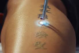 Professional tattoo artists and longtime body art collectors tend to forget what it was like to be on the other side of the chair for the first time. Laser Tattoo Removal Pain How Much Does It Hurt Authoritytattoo