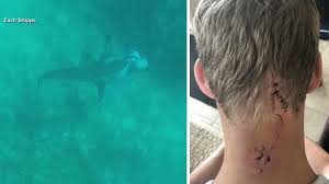 Maybe you would like to learn more about one of these? Man Survives Being Bitten On Head By Shark While Spearfishing In The Bahamas Abc7 New York