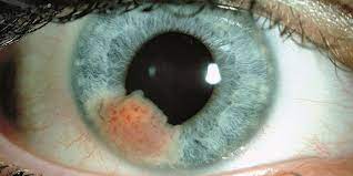 Eye melanoma can be a stage 1, 2, 3, or 4. Eye Cancer American Academy Of Ophthalmology