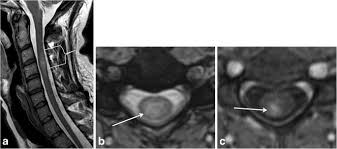Maybe you would like to learn more about one of these? Location Length And Enhancement Systematic Approach To Differentiating Intramedullary Spinal Cord Lesions Insights Into Imaging Full Text