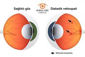 Goze Yabanci Cisim Kacarsa Bunlari Yapmayin Bursa Goz Merkezi Yildirim Goz Hastaliklari Hastanesi