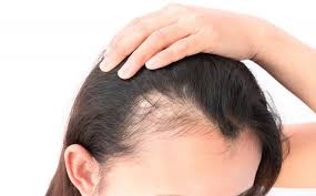 There is a connection between estrogen and hair loss. Did You Know Hormones Can Be The Cause Of Hair Loss In Females