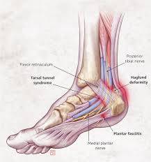 Heel Pain Diagnosis And Management American Family Physician