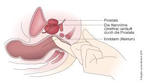 Die prostatauntersuchung ist eine wichtige vorsorgeuntersuchung, die der krebsvorsorge bezüglich prostatakrebs dient. Prostatitis Chronische Deximed