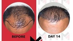 As a consequence, the hair's growth phase (anagen) is shortened, and young, unpigmented vellus hair is prevented from growing and maturing into a. Stem Cell Hair Therapy Restore Growth Of Natural Hair Follicles Istanbul Trambellir