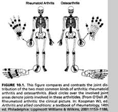 Rheumatoid Arthritis Vs Osteoarthritis Arthritis Rhumatoid Arthritis Osteoarthritis