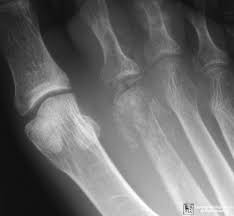 Image result for Osteomyelitis