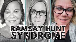 The Face of Ramsay Hunt Syndrome. This past weekend marked 125 days since… 
