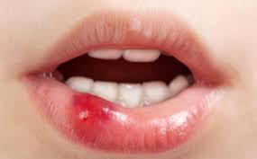 Walau akan hilang dengan sendirinya, kita tetap berharap ada cara mengobati sariawan yang efektif. Cara Mengobati Sariawan Secara Alami Bisa Gunakan 5 Bahan Ini Tribunnews Com Mobile