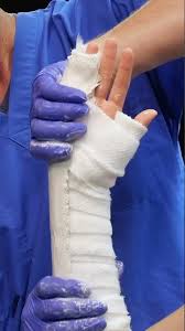Image result for Ulnar Gutter Splint