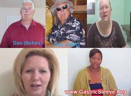Weight Loss Surgery Mexico Reviews Gastric Sleeve Surgery